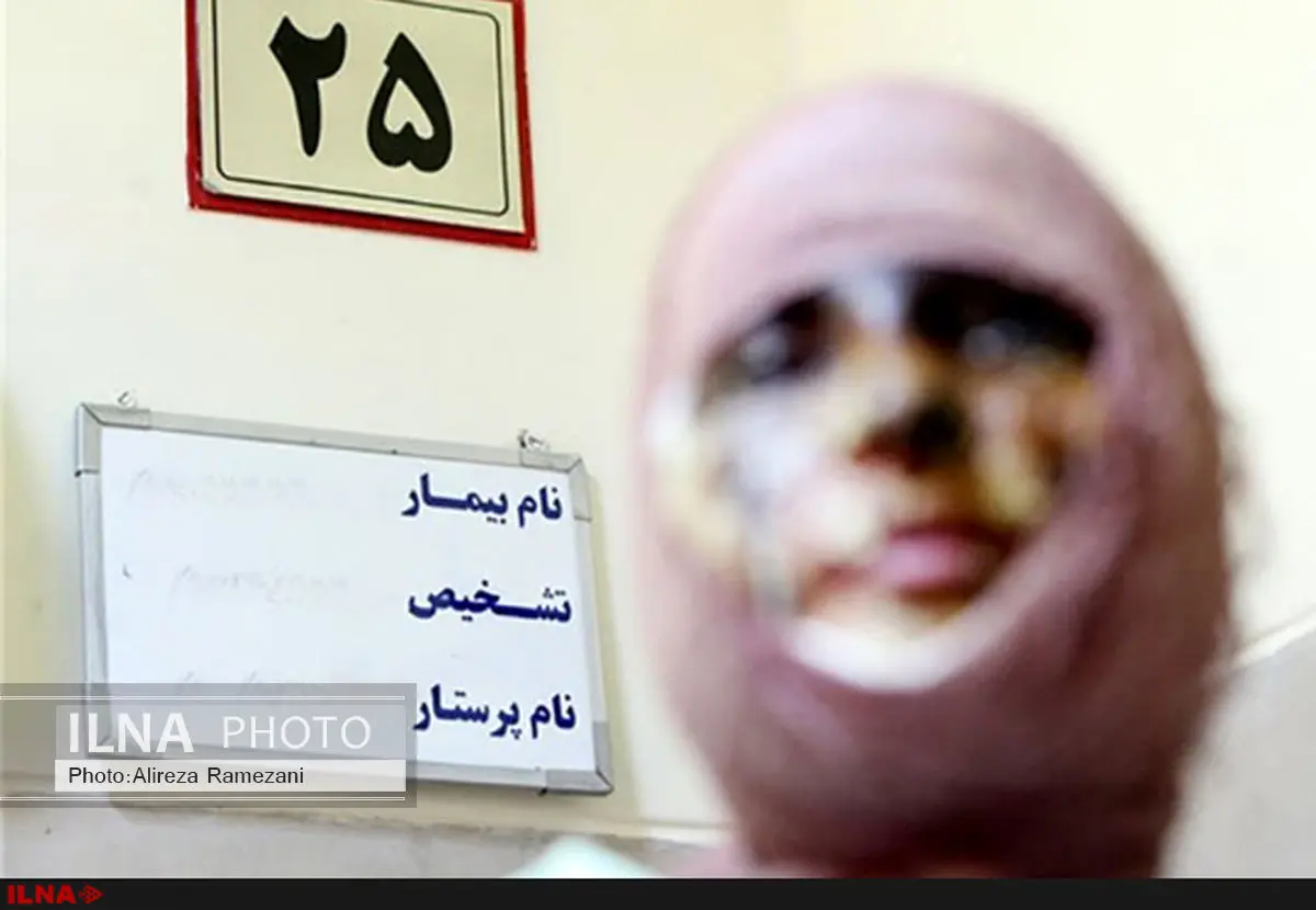 سوختگی 14 درصدی دختر 25 ساله بر اثر اسیدپاشی/ چشمهایش آسیب جدی ندیدهاند