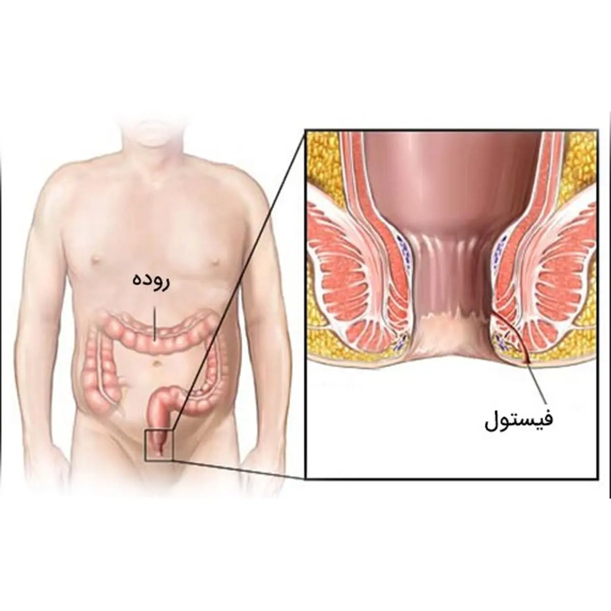 لیزر بهترین روش درمان فیستول مقعدی