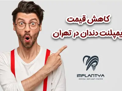 کاهش قیمت ایمپلنت دندان در تهران