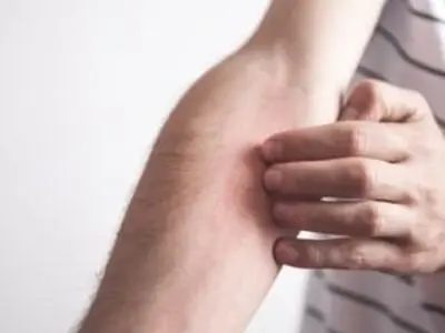 علل حساسیت به نور خورشید و کهیر زدن پوست زیر آفتاب