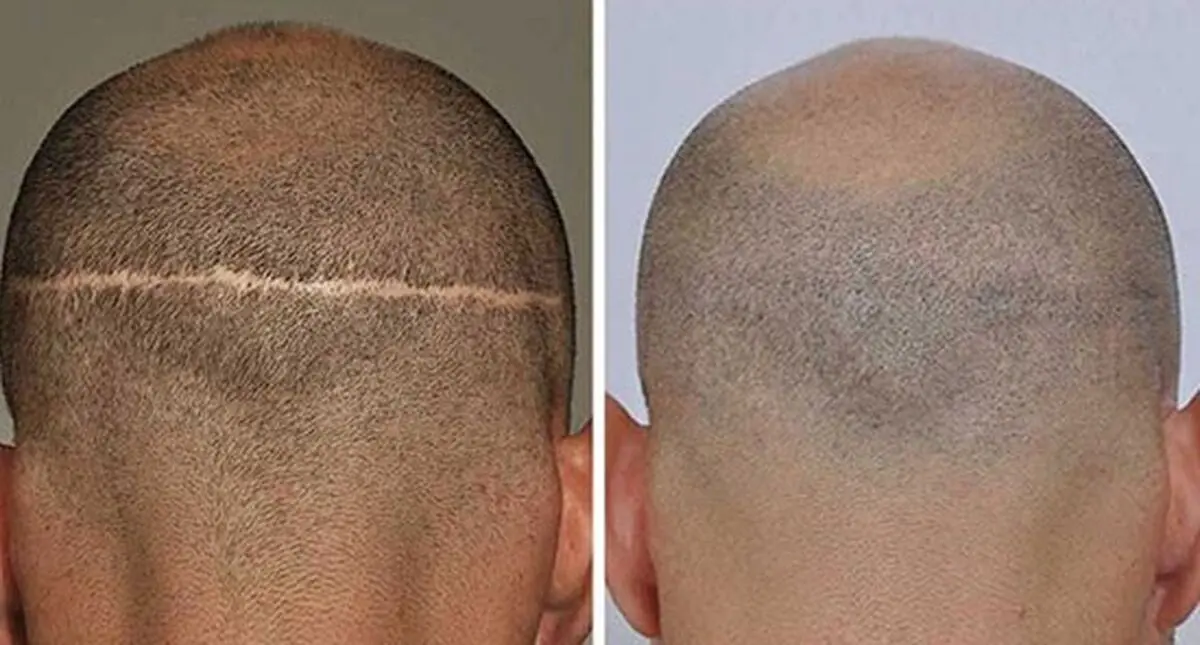 بررسی جامع کاشت مو و کاشت ابرو و هزینه های کاشت موی سر