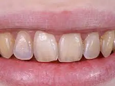 برای تقویت مینای دندان چه کنیم؟