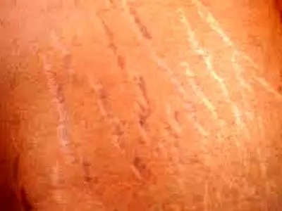 چه عواملی باعث ایجاد ترک‌های پوستی می‌شوند؟ + فیلم