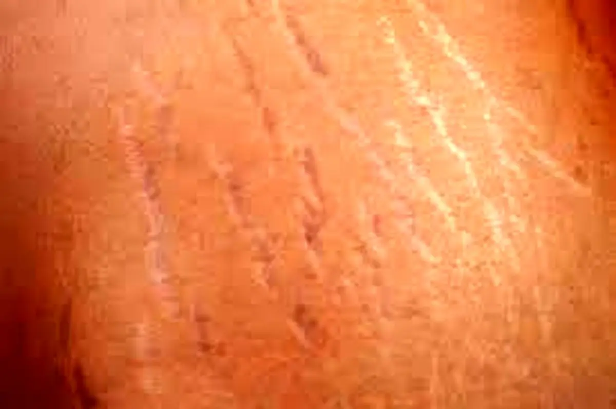 چه عواملی باعث ایجاد ترک‌های پوستی می‌شوند؟ + فیلم