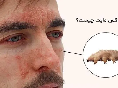 دمودکس‌ها؛ انگل‌های مضری که در سطح پوست شما هستند!