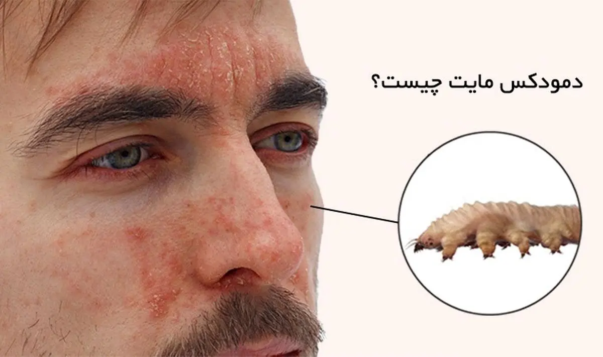دمودکس‌ها؛ انگل‌های مضری که در سطح پوست شما هستند!