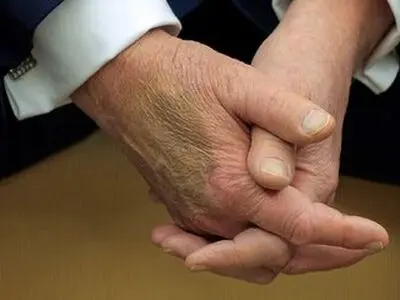 کبودی خبرساز روی دست ترامپ / آیا ترامپ سالم است؟ / کاخ سفید: کبودی ناشی از دست دادن زیاد است