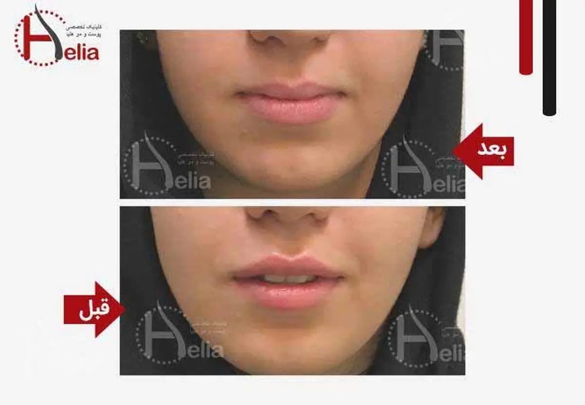 تزریق ژل و چربی چه تفاوتی با یکدیگر دارند؟
