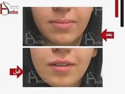 تزریق ژل و چربی چه تفاوتی با یکدیگر دارند؟
