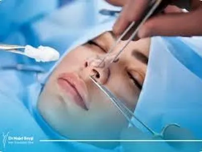  پیشگیری از افتادگی نوک بینی بعد از عمل