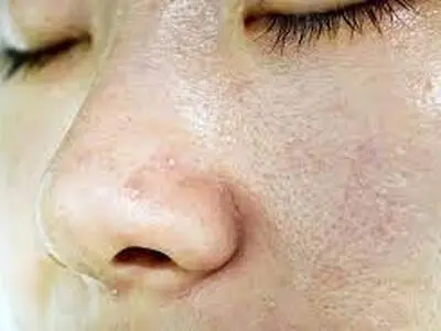 چطور چربی پوست را کاهش دهیم؟
