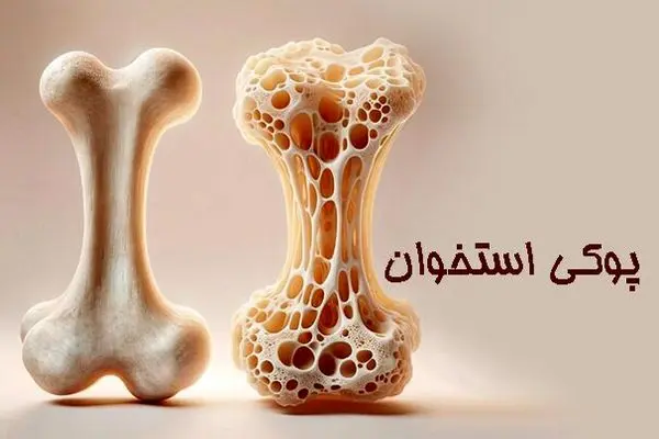 بیماری خاموشی که زنان را بیشتر از مردان تهدید می‌کند