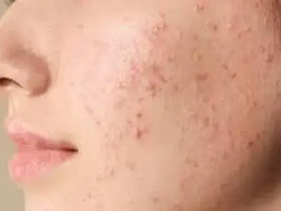 این ویتامین برای جوش و آکنه صورت معجزه می‌کند 