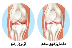 درمانی نوین برای آرتروز زانو: آیا تزریق عصاره جفت جایگزین جراحی خواهد شد؟