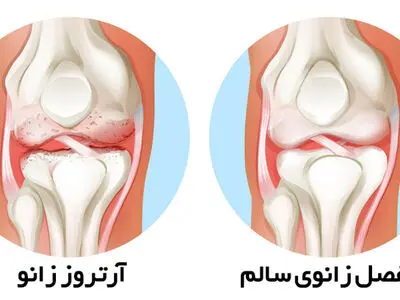 درمانی نوین برای آرتروز زانو: آیا تزریق عصاره جفت جایگزین جراحی خواهد شد؟