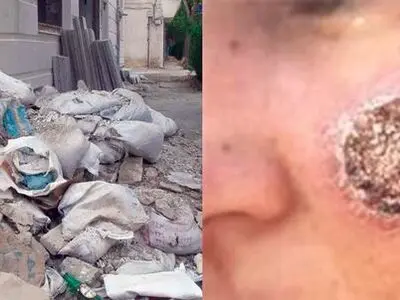 شایع شدن بیماری سالک در 17 استان کشور / افزایش شیوع  سالک در اصفهان و جنوب دامغان 
