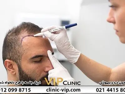 چگونه بهترین کلینیک کاشت مو در تهران را انتخاب کنید؟