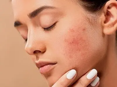 چه محصولاتی برای از بین بردن جوش پوست موثر است؟