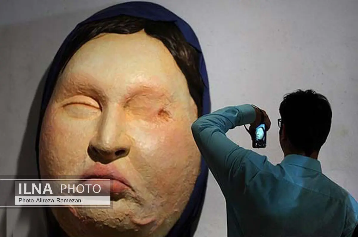 رنج‌های قربانی اسیدپاشی روی صحنه جان می‌گیرد