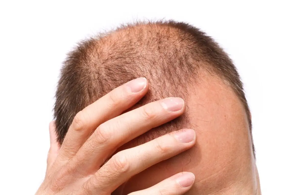 برای جلوگیری از ریزش مو چه بخوریم