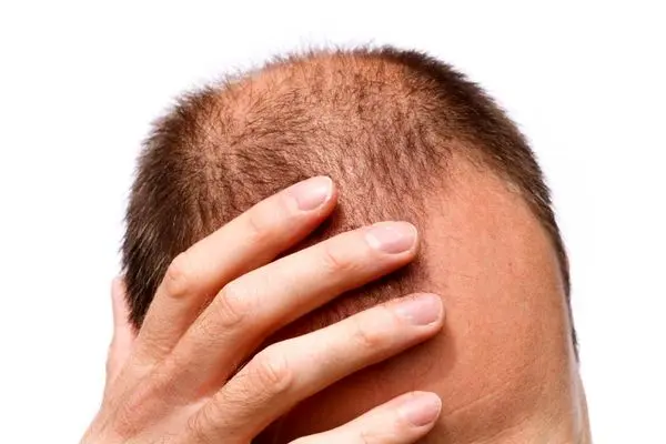 برای جلوگیری از ریزش مو چه بخوریم