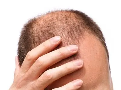 برای جلوگیری از ریزش مو چه بخوریم