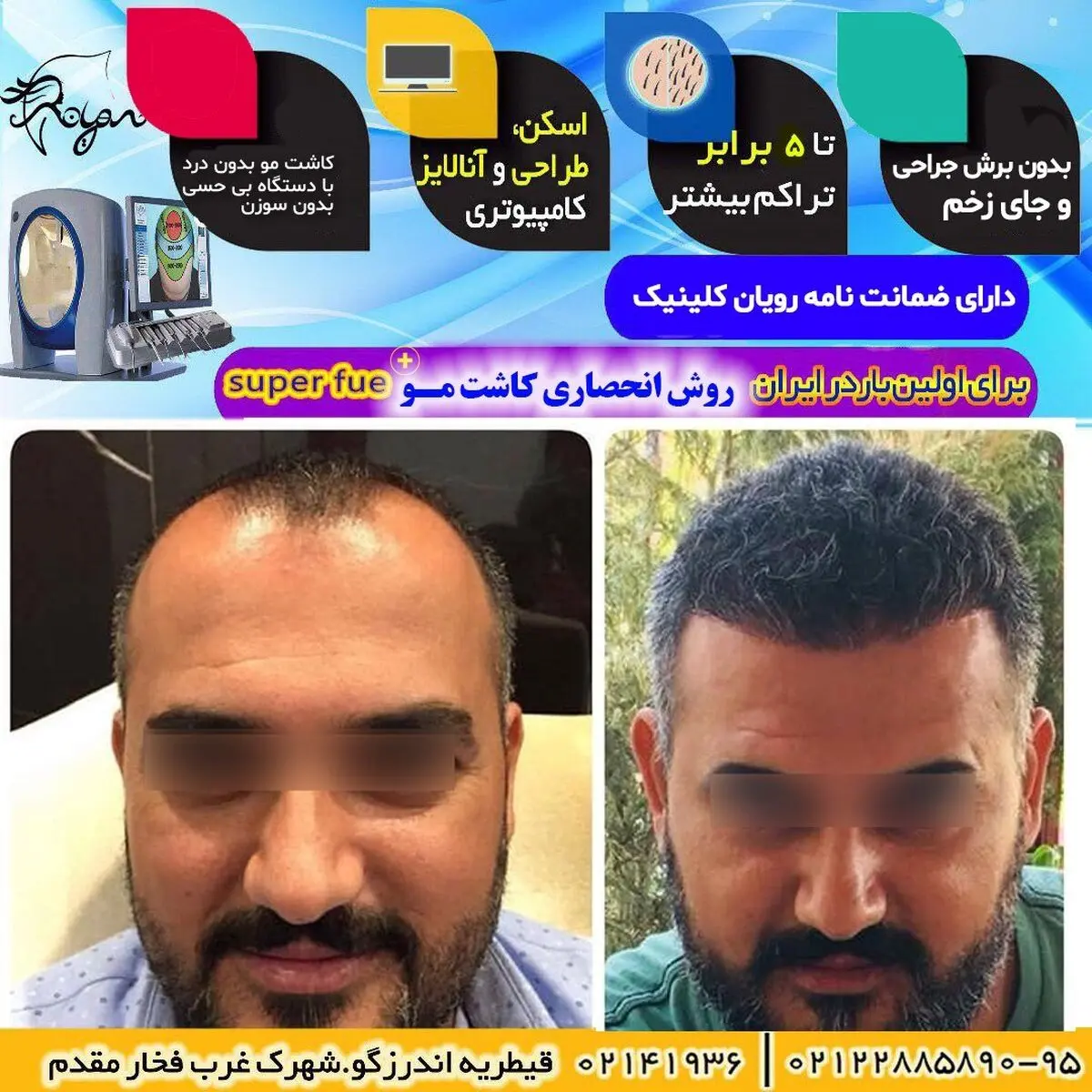 مقایسه انواع روش‌های کاشت مو، بهترین روش کاشت مو کدام است؟
