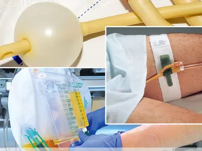 خدمات سونداژ بیماران در منزل توسط موسسه درمانی آلفاطب