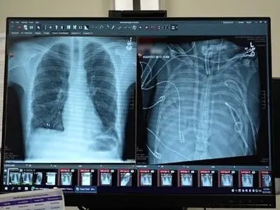 مردی ۴۸ ساعت بدون ریه زنده ماند!