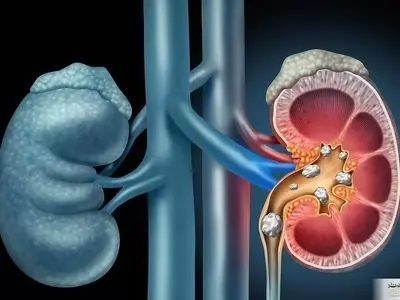 عضو حیاتی بدن شما بدون علامت از کار می افتد