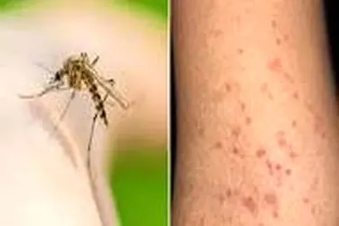 افزایش تعداد مبتلایان بیماری تب دنگی در استان هرمزگان به 255 نفر