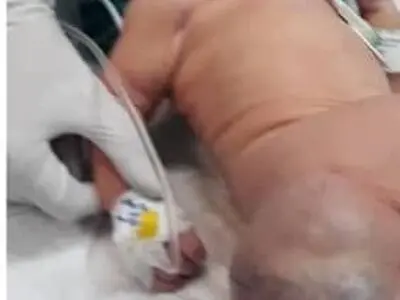 انجام عمل جراحی نادر تومور از بدن نوزاد ۴ روزه