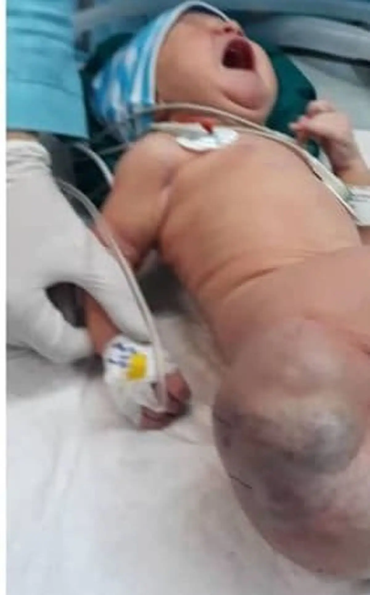 انجام عمل جراحی نادر تومور از بدن نوزاد ۴ روزه