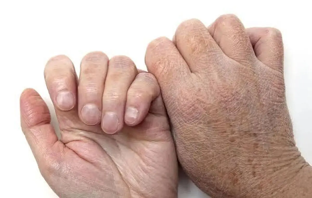 راهکار رفع خشکی پوست‌ ناشی از سرد شدن هوا 