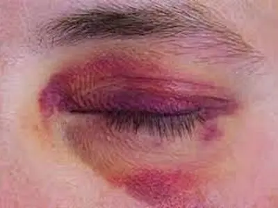 دیه کبودی و کوفتگی اعضای بدن چقدر است ؟