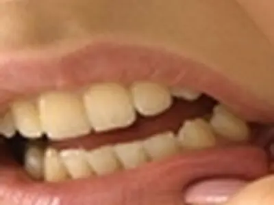 دندان قروچه از عوامل ایجاد دردهای مزمن در سر و صورت