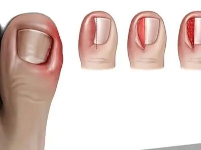 چگونه از رشد ناخن در گوشت پا جلوگیری کنیم؟