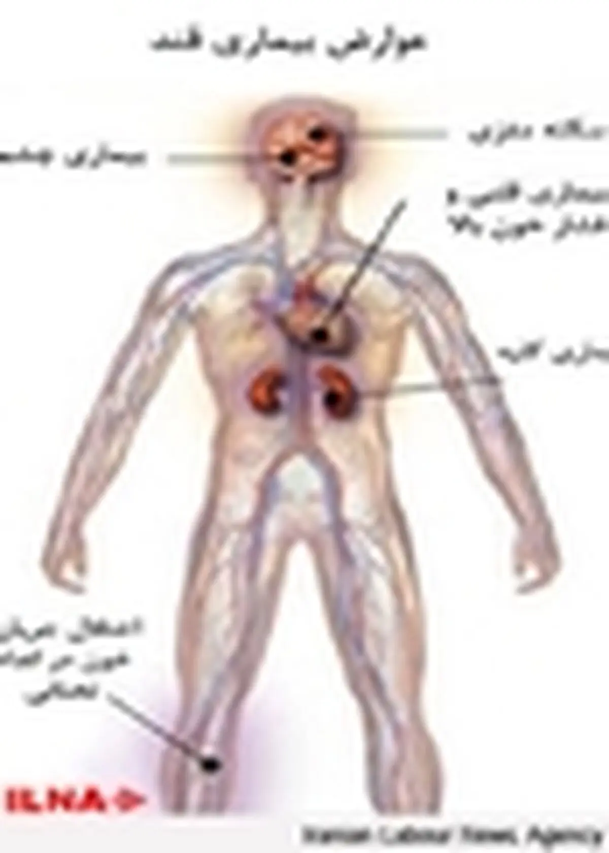دیابت عامل ۶۰ درصد مرگ و میرها