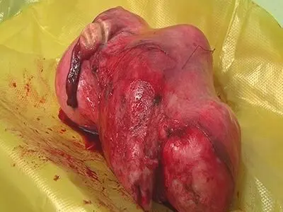 خروج توده 3 کیلویی از شکم زن 49 ساله سبزواری+ تصاویر 