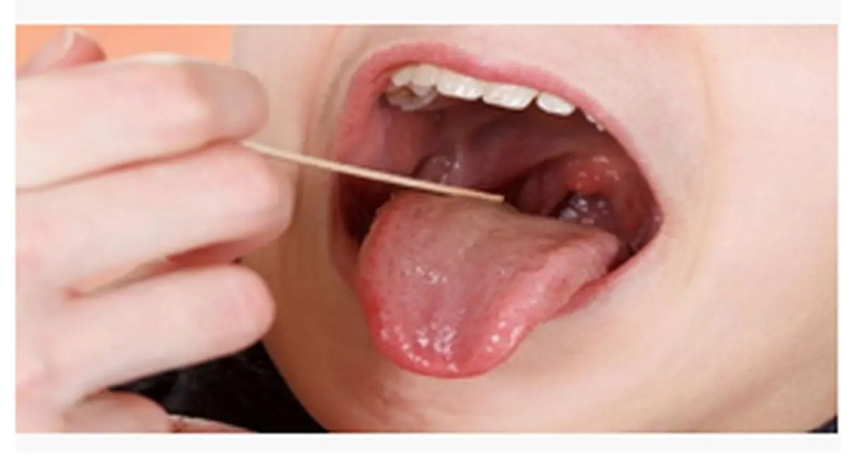 نقش لوزه‌ها در سیستم ایمنی بدن