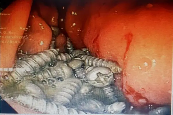 از معده یک بیمار کرجی  ۴۷ پیچ فلزی بدون جراحی خارج شد 