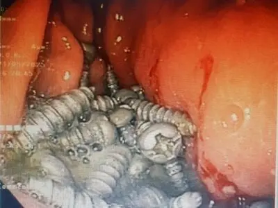 از معده یک بیمار کرجی  ۴۷ پیچ فلزی بدون جراحی خارج شد 