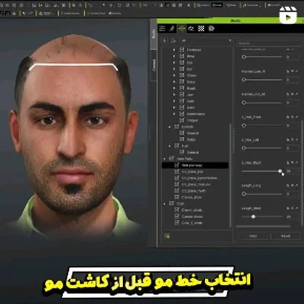 بهترین کلینیک کاشت مو در ایران کجاست؟
