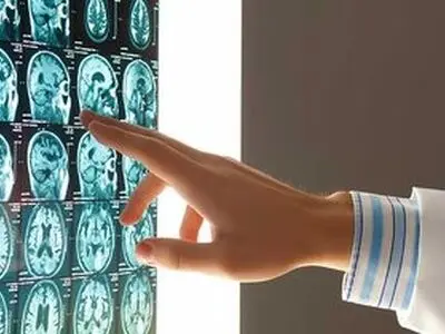 این گروه‌های خونی بیشتر در معرض سکته مغزی در سنین پائین هستند
