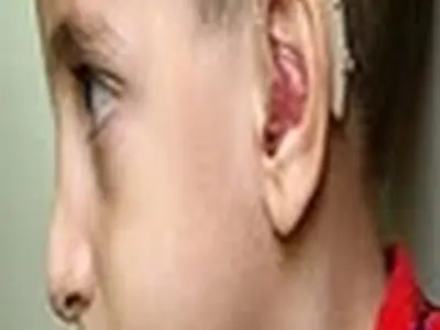 پرداخت کمک هزینه سی میلیون ریالی کاشت حلزون گوش