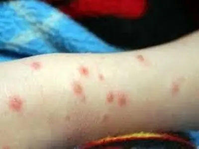 کاهش ۴۵ درصدی شمار مبتلایان به تب مالت در شهرستان فراهان 