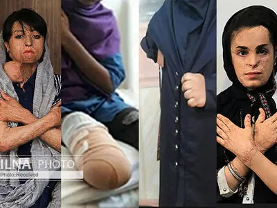 آغاز سال تحصیلی جدید با عمل‌های جراحی مکرر، رویای دست مصنوعی و ناامیدی از وعده‌های توخالی 