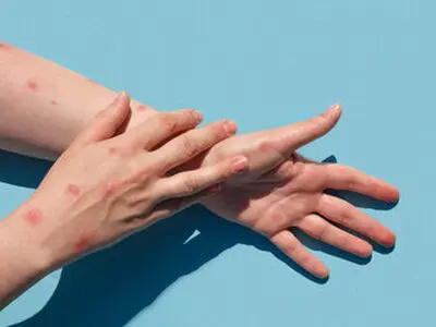 تعطیلی مدارس به‌دلیل شیوع «آبله میمونی»؟