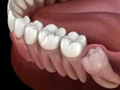 بیماری لثه خطر سکته مغزی را افزایش می دهد