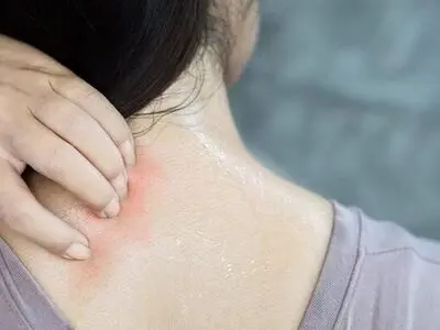 نکات طلایی برای پیشگیری و درمان عرق‌سوز شدن